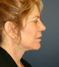 Feel Beautiful - Neck Lift Surgery San Diego - After Photo